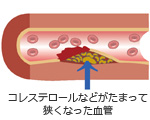コレステロールなどがたまって狭くなった血管